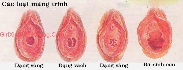 Hình ảnh các loại màng trinh ở phụ nữ